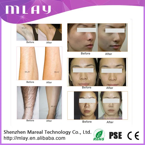 2016 The most popular home use IPL laser hair removal machine with 3 replaceable lamps 120000 flashes