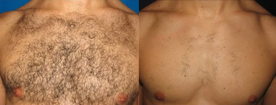 CE E-light IPL SHR Hair Removal Machine/ Elight SHR/ Shr Laser Ipl Skin Rejuvenation