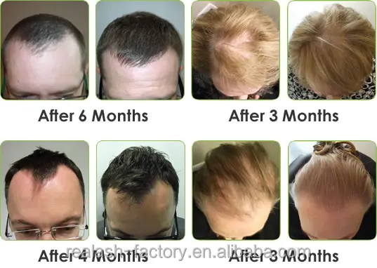 If You Have Thinning Hair But Not Aggressive Balding Scalp Massage