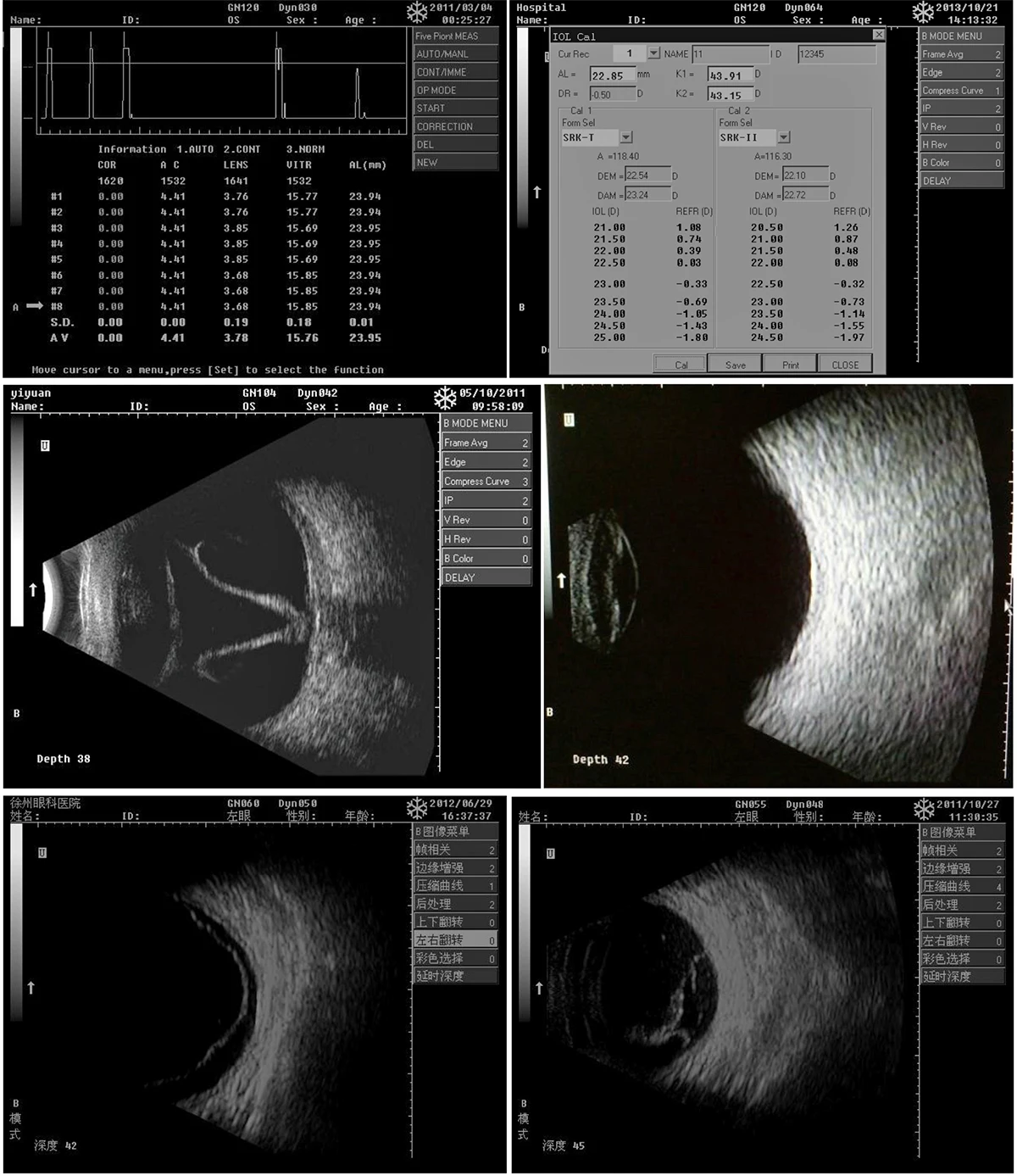 odu 5 便携式眼科超声,a b 扫描仪,ab 扫描