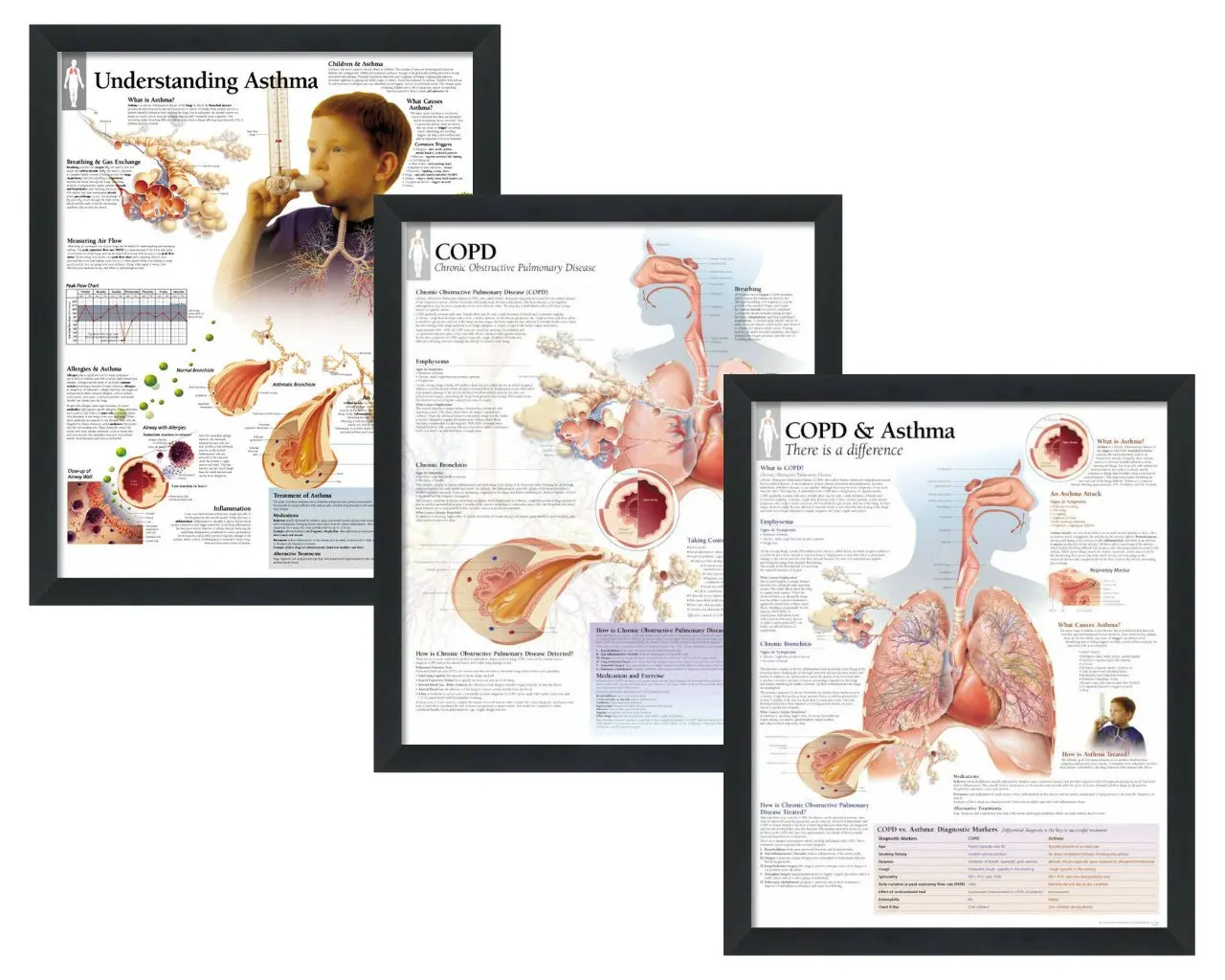Buy Set Of 3 Framed Medical Posters Understanding Asthma - 