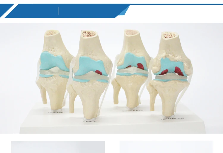 4 Stage Osteoarthritis Knee Model - Educational Tool
