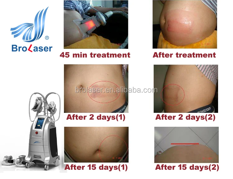 Apparatus ice Fat Slimming Machine