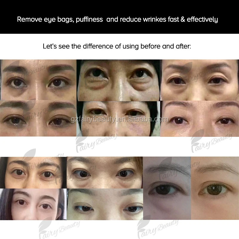 eye bag cream before and after