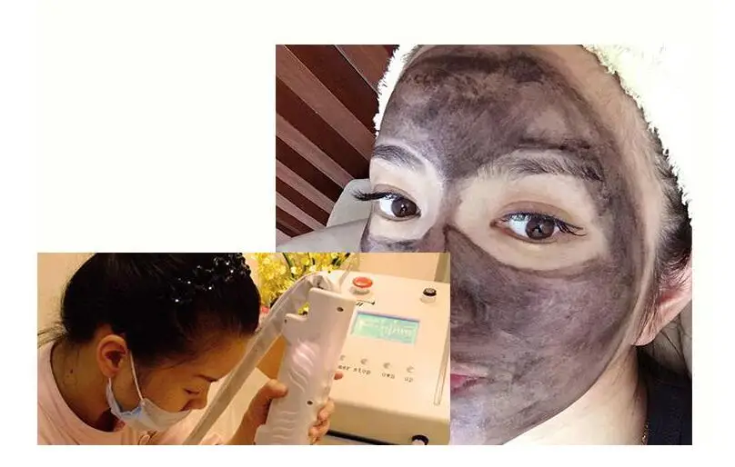 Carbon gel Nd Yag Laser Peeling Facial Whitening
