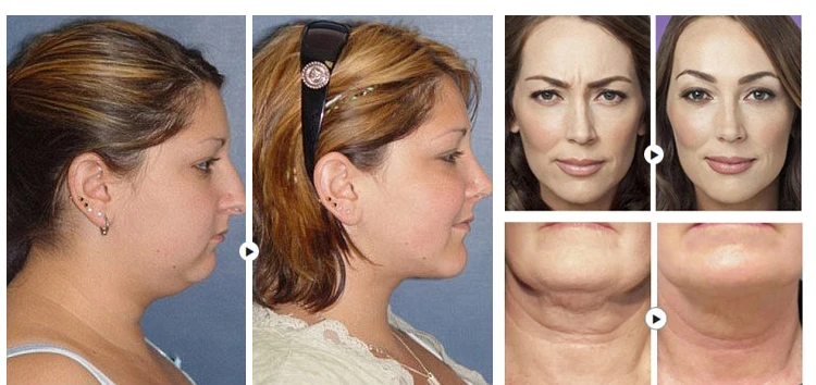 professional thermagic fractional rf skin tightening machine/radio frequency facial machine for sale