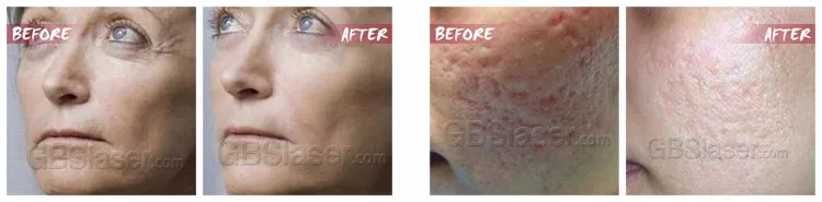dermapen before and after.jpg