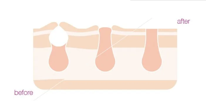 cosbeauty at home permanent commercial 808nm diode laser ipl back body hair removal machine/device price