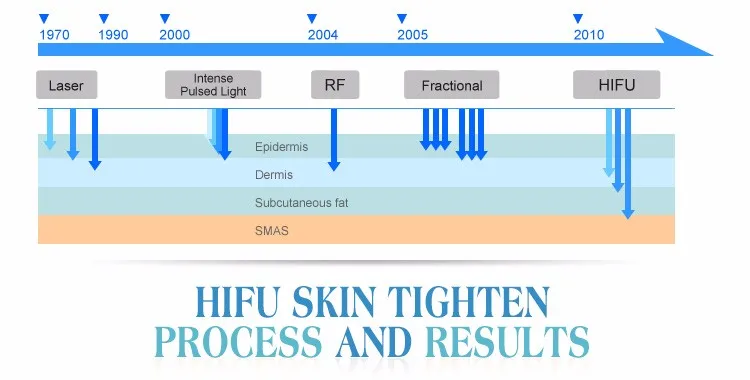 Professional medical korea smas hifu facial lifting machine