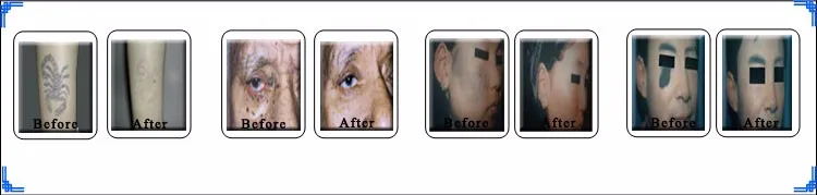 Cost-effective Newest Nd Yag Laser Machine Prices Tattoo Removal Nd Yag Laser Machine For Sale