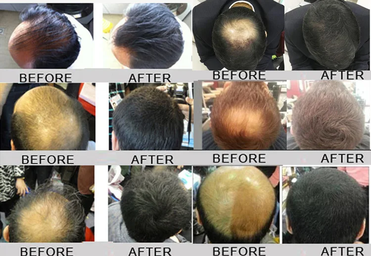 Fda Eu Approved Fully Hair Building Fibers Conceal Anti Thinning
