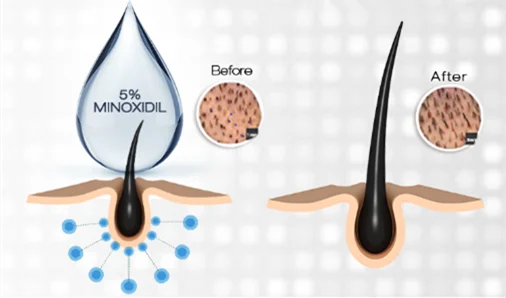 minoxidil..png