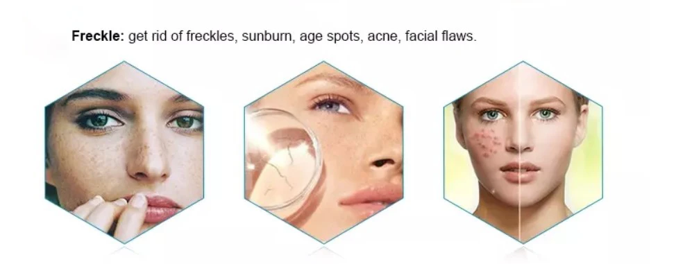 opt ipl rf nd yag best laser hair removal and skin rejuvenation machine magneto optic