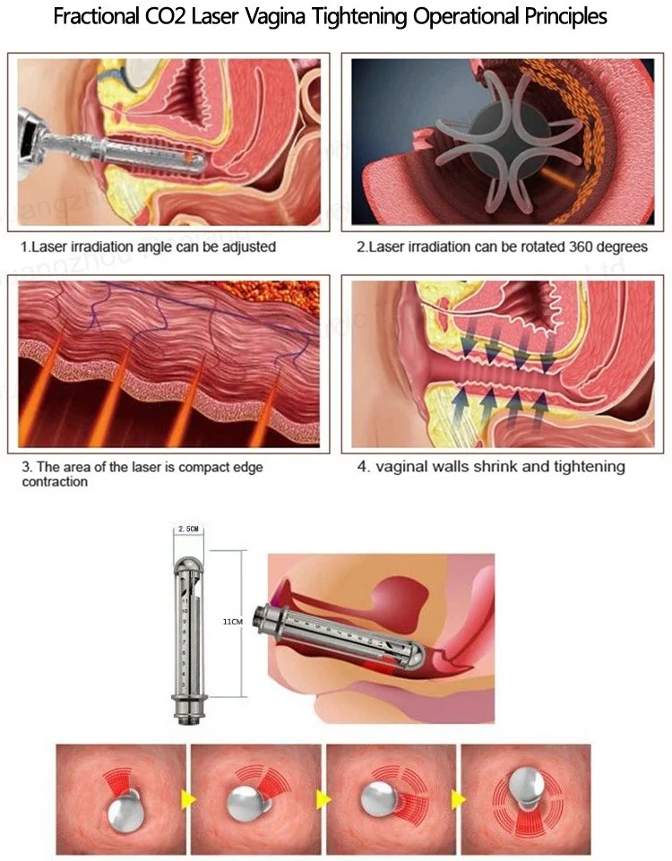 Fractional CO2 Laser.jpg