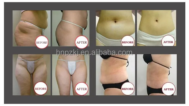 2016 New Launched Zero Cryo Lipo Machine Portable Cold Laser