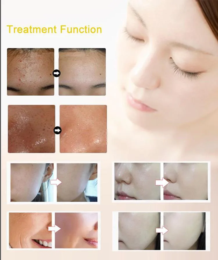 Luz para Rejuvenescimento da Pele Profissional Coreia Tecnologia Omega Tratar Acne 9 Beleza e saúde