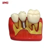 Dental Dentist Demonstration Teeth Model Implant Analysis Crown Bridge good