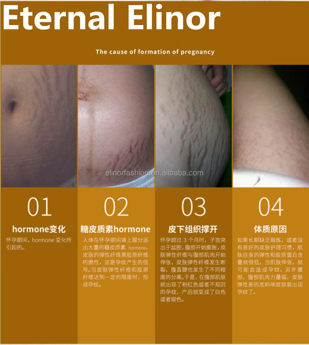 stretch marks-03.jpg