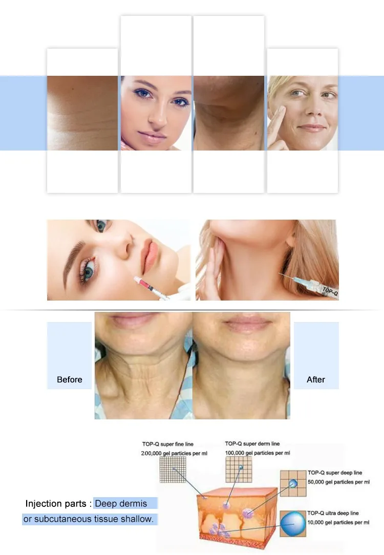 Top-Q super ultra deep line 2ML hyaluronic acid dermal fillers benefits in skin care