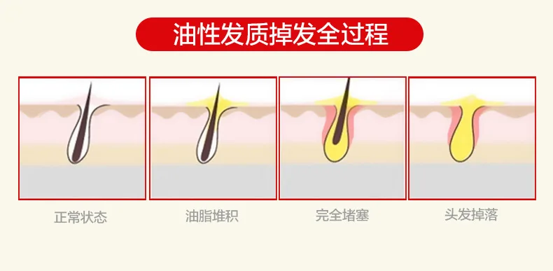 Resistência à Perda de Crescimento do Cabelo Cuidado do Cabelo Preto e Brilhante Shampoo Cabelo Tratamento Profissão Mostrando Suave 3 Shampoo cabelo Tratamento Profissão Mostrando Resistência À