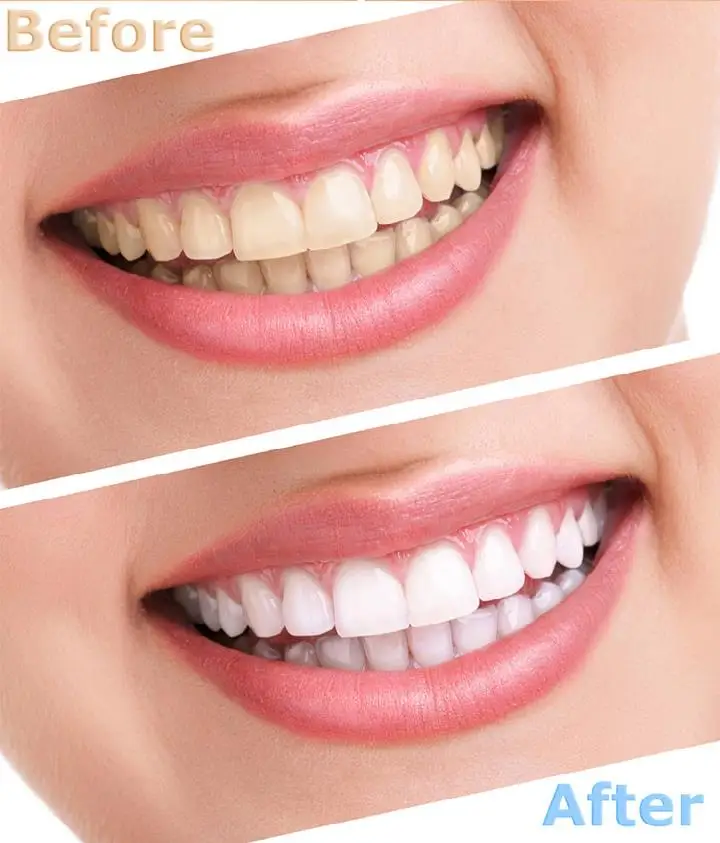 China Professional Teeth Whitening Machine Dental Laser Teeth Bleaching Machine - Buy Teeth Bleaching Machineteeth Whitening Lightteeth Whitening Machine Lamp Product On Alibabacom China Professional Teeth Whitening Machine Dental Laser Teeth Bleaching Machine - Buy Teeth Bleaching Machineteeth Whitening Lightteeth Whitening Machine Lamp Product On Alibabacom
