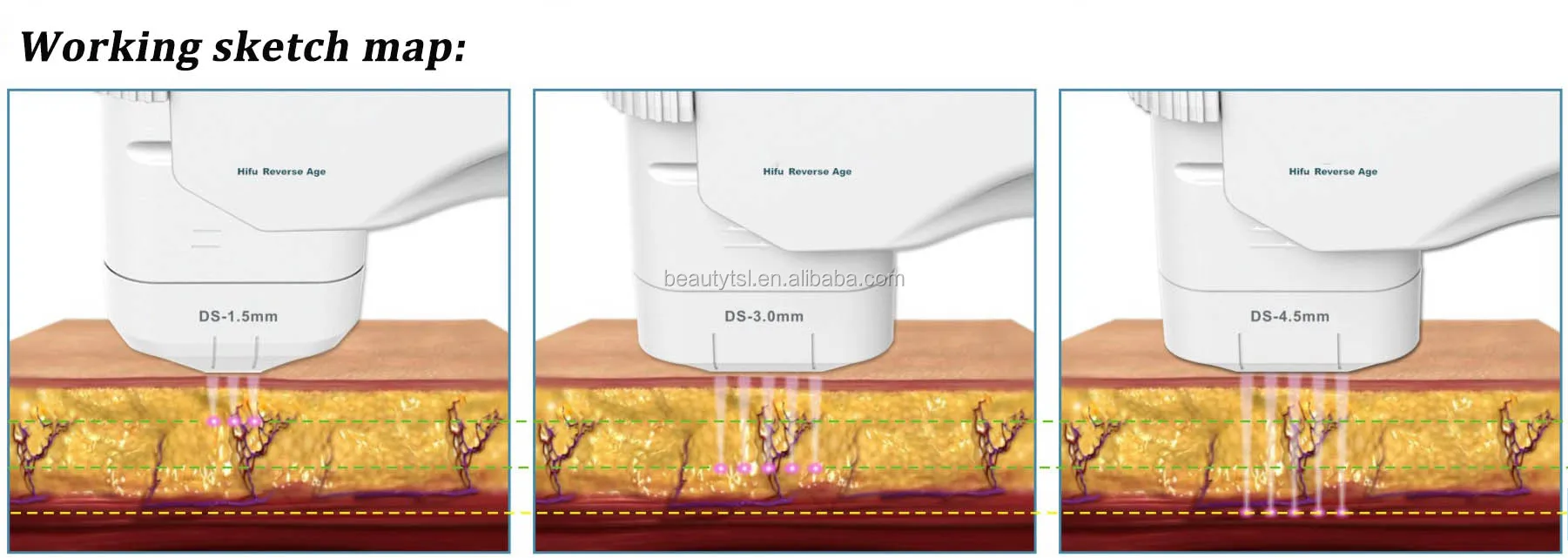 LINGMEI Beauty Salon FU4.5-3S HI FU High Intensity Focused Ultrasound HIFU Face Lift Ultra Age HIFU Machine