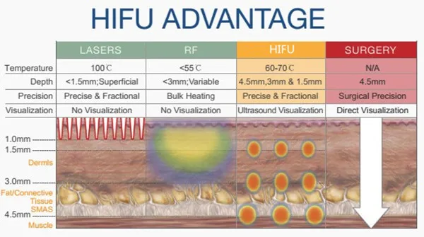 hifu machine face lift 12 lines 4 d hifu smas vaginal vmax wrinkle removal machine