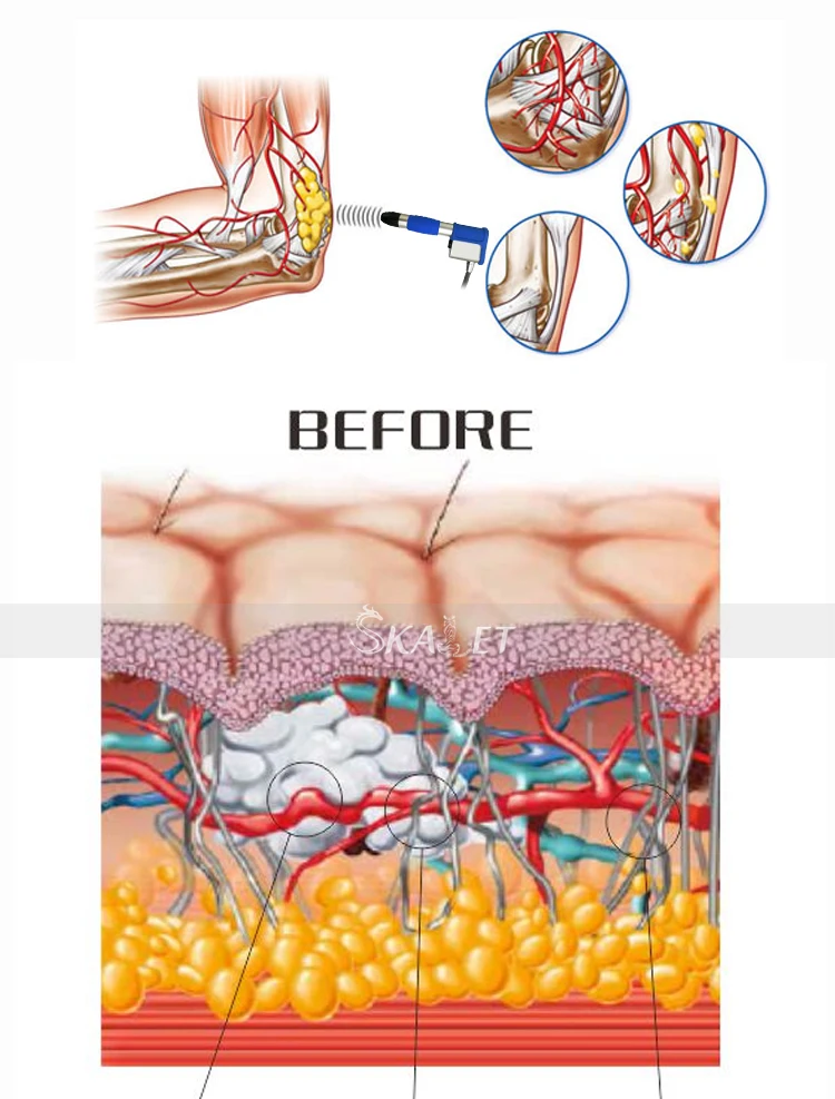Perfect Effect Erectile Dysfunction Shockwave Machine Body Slimming Body Pain Relief For Clinic Use