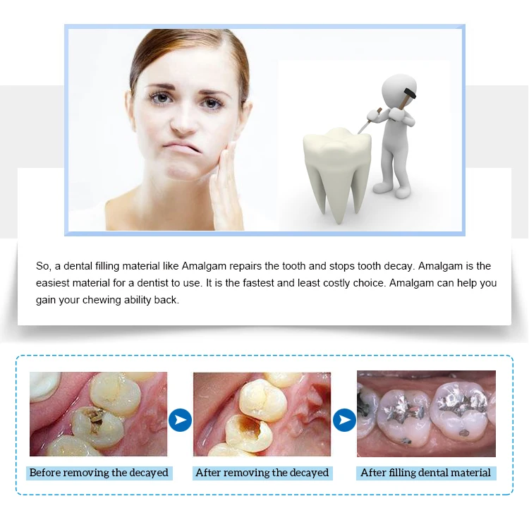 Original Dental Amalgam Capsules Composition 43ag 32sn 25cu Buy Original Dental Amalgam