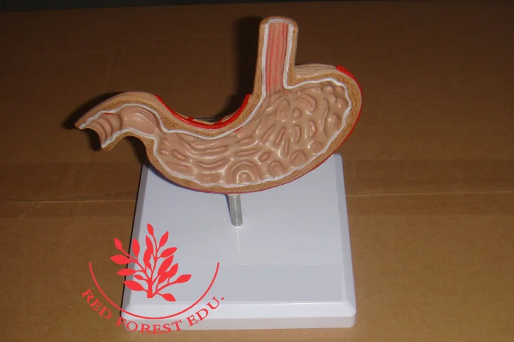 Gastric Ulcer Model Pathological Stomach Model - Buy Pathological Model ...