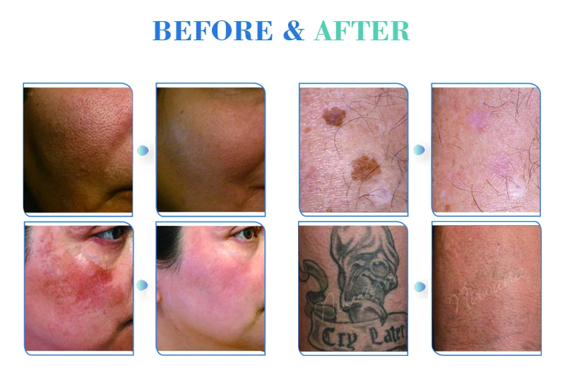 CE /FDA approved 1500mj 1-10hZ quick laser tattoo removal picolaser