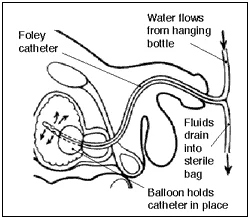 Foley_catheter_in_place.png