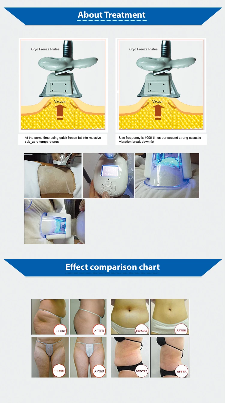 Cryolipolysis fat freeze slimming machine, spare parts cryolipolysis machine 2017