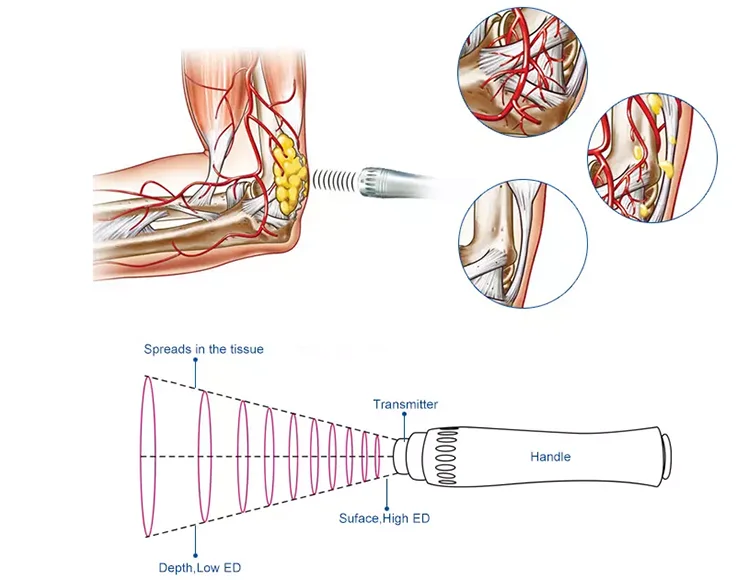 Pain Removal Electromagnetic Therapy Machine