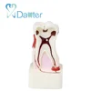 Best Selling Teaching 4 Times Caries Pathological Dental Model for the Progress of Caries
