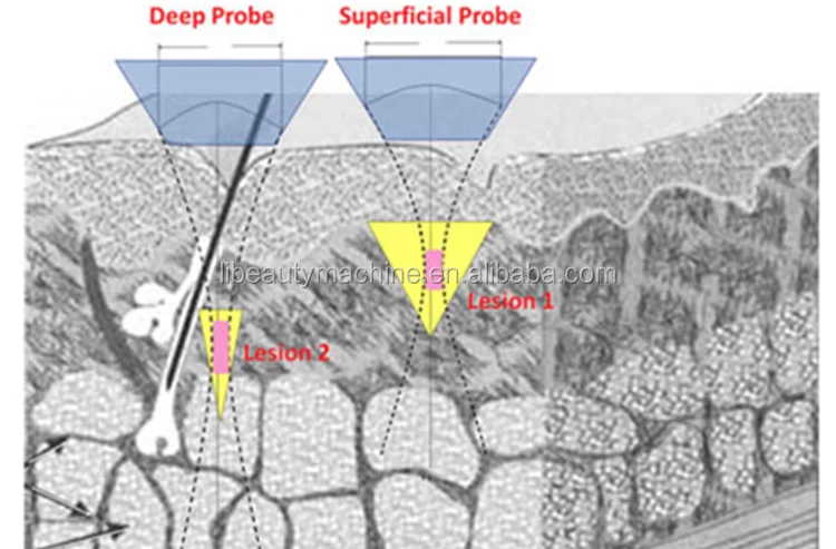 2018 New Beauty Equipment Vmax Cartridge Ultrasound Body Slimming Machine