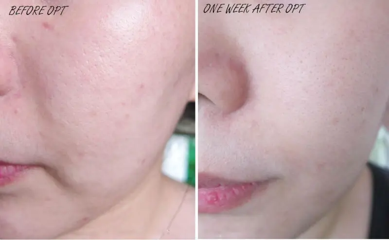 handled shr ipl hair removal laser machine with 650 - 950 nm wavelength