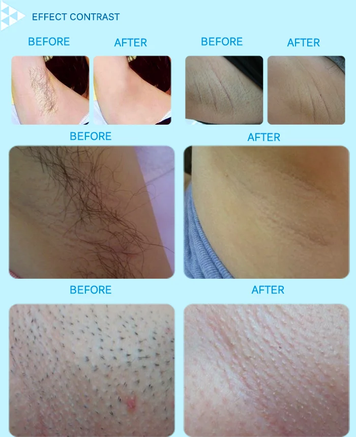 808nm diode laser hair machine