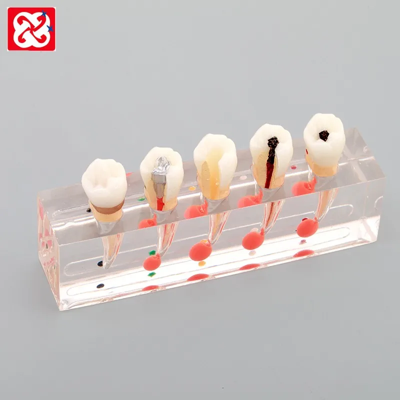 Dental Study Model Endodontic Treatment Process Dental Model Patient