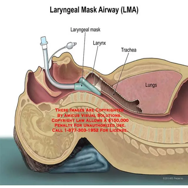 麻醉喉罩图片