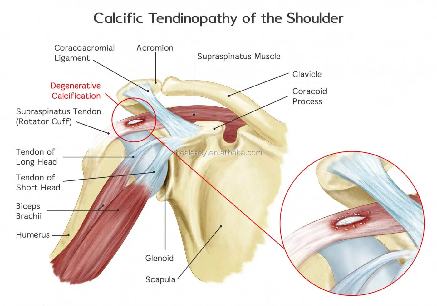 Тендинопатия сухожилия плечевого сустава