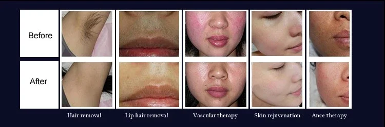 Ipl laser hair removal machine to remove face hair bikini hair