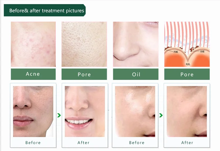 Korea Popular Vacuum Facial Pore Cleaner Blackhead Remover Suction  06.jpg