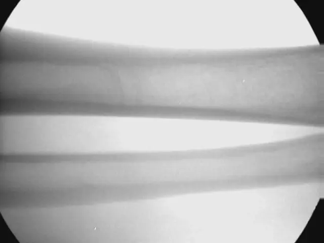 LCD Low-Intensity Portable X-Ray Imaging Scope