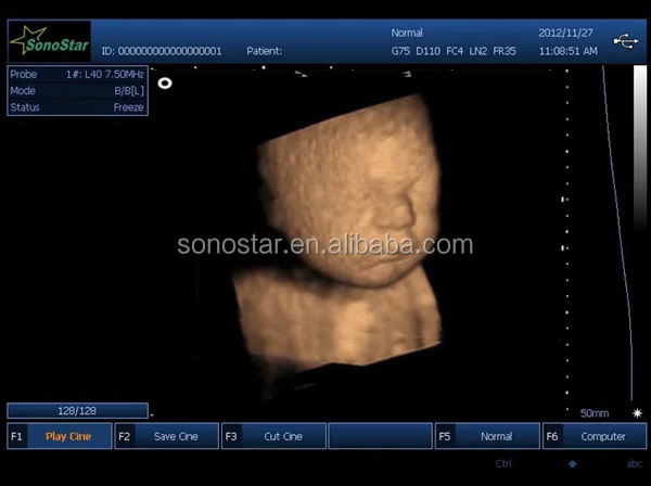 Ultrasound B Scanner Portable B Scanner SS 10Plus(xjt)01