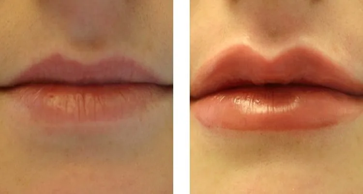 2cc Lip Hyaluronic Acid Filler Injections Beauty Injectable - Buy ...