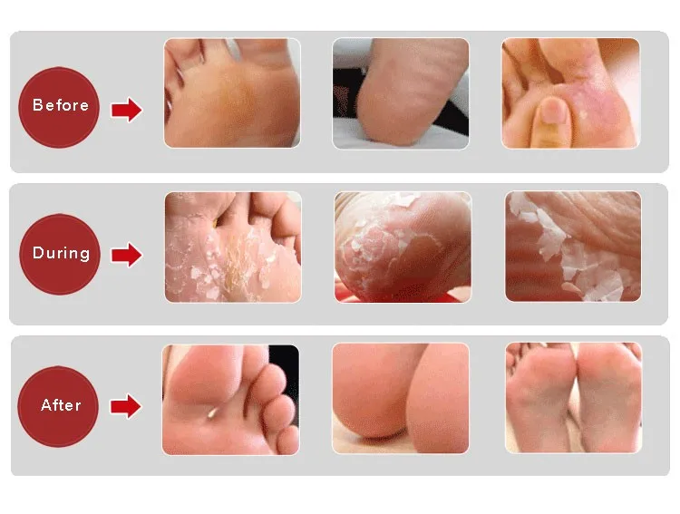 thick dead skin on feet thick dead skin on feet