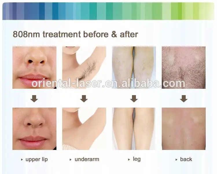 Body And Face Epilator Hair Removal Portable Laser Hair Remover