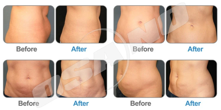 lipo cryo cavitation
