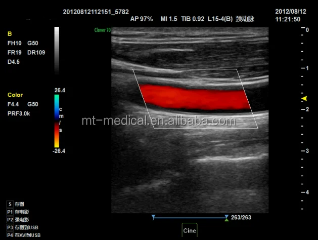 Medical Ultrasound More Than Two Probe Socket Portable Scanner
